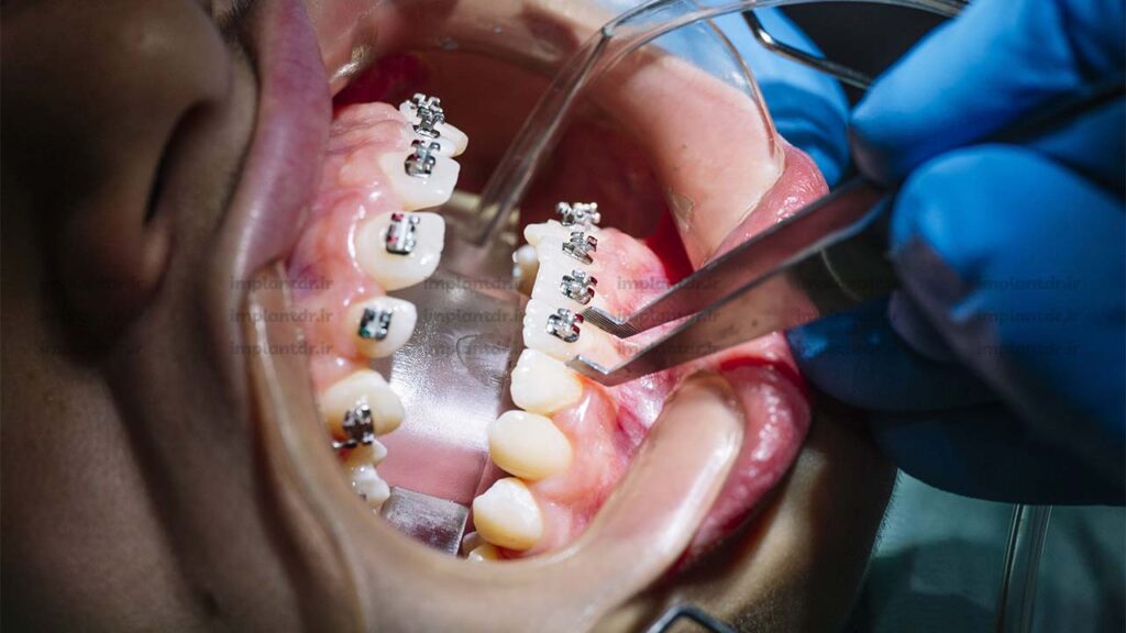 برداشتن براکت ها