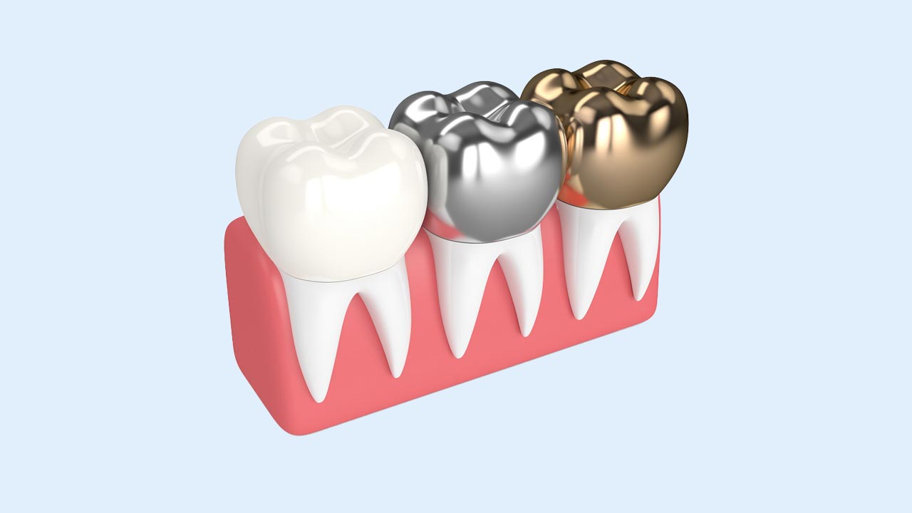 3 نوع روکش دندان