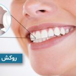روکش دندان جلو