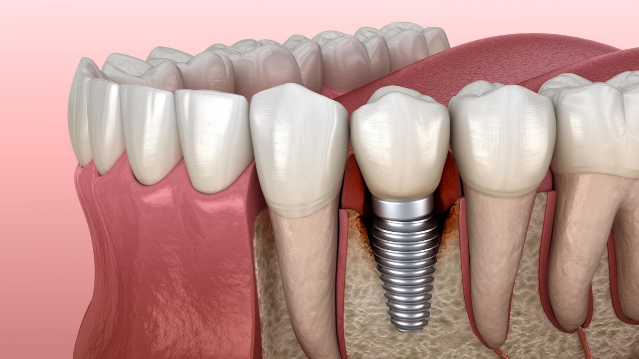 قرارگیری ایمپلنت دندان در بین دندانها