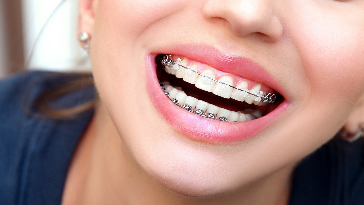 ارتودنسی دیمون چیست؟ عملکرد، مزایا و معایب 