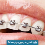 ارتودنسی دیمون