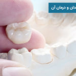 افتادن روکش دندان