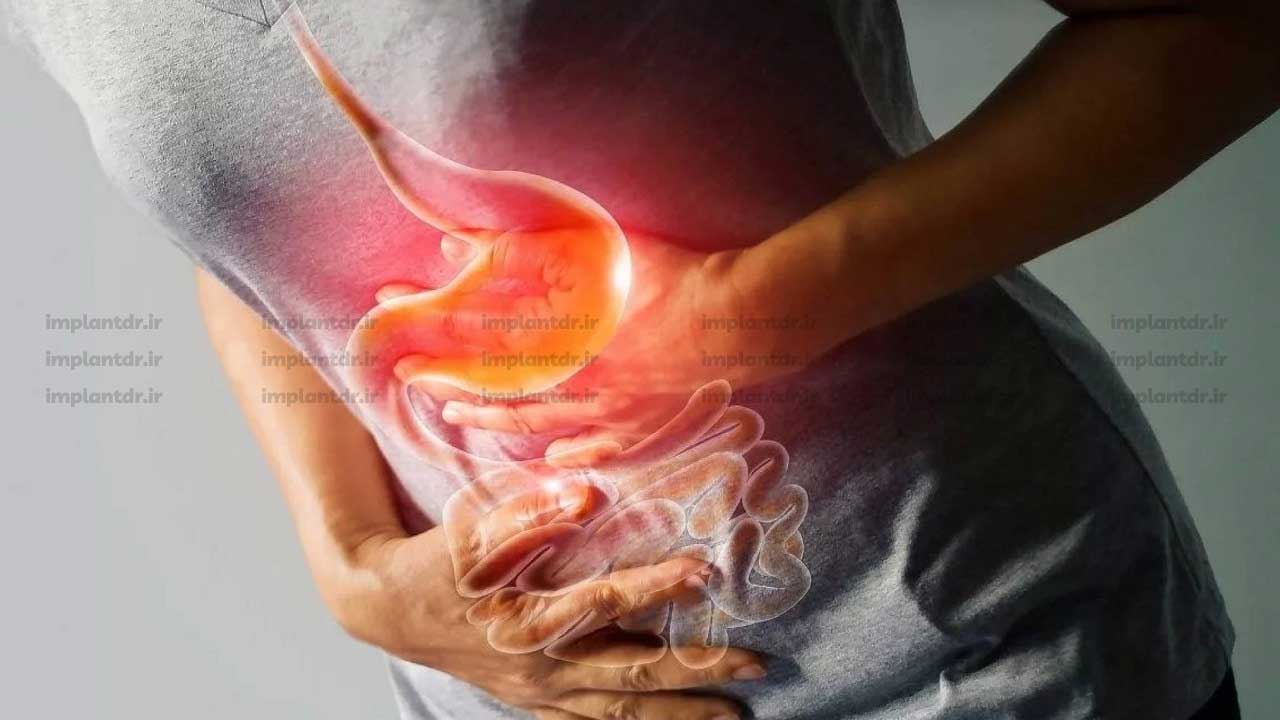 ریفلاکس معده
