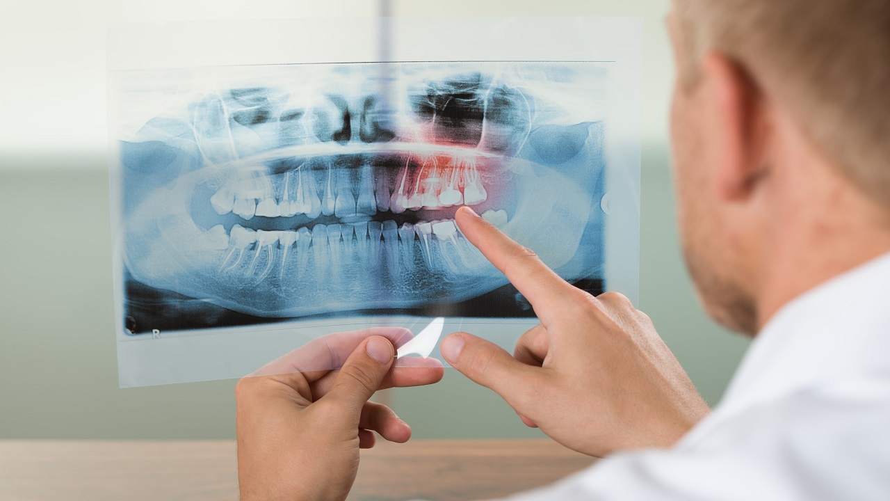 مشاهده عکس رادیوگرافی از دندان توسط دندانپزشک