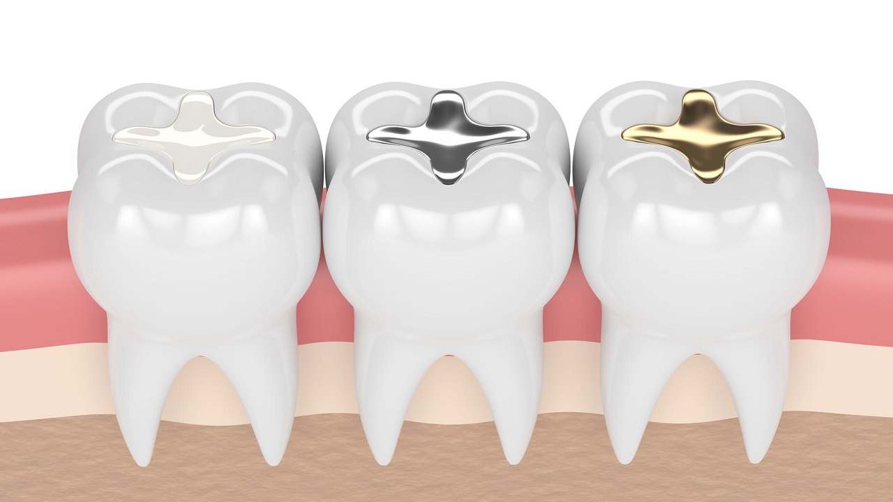 انواع مواد پر کردن دندان