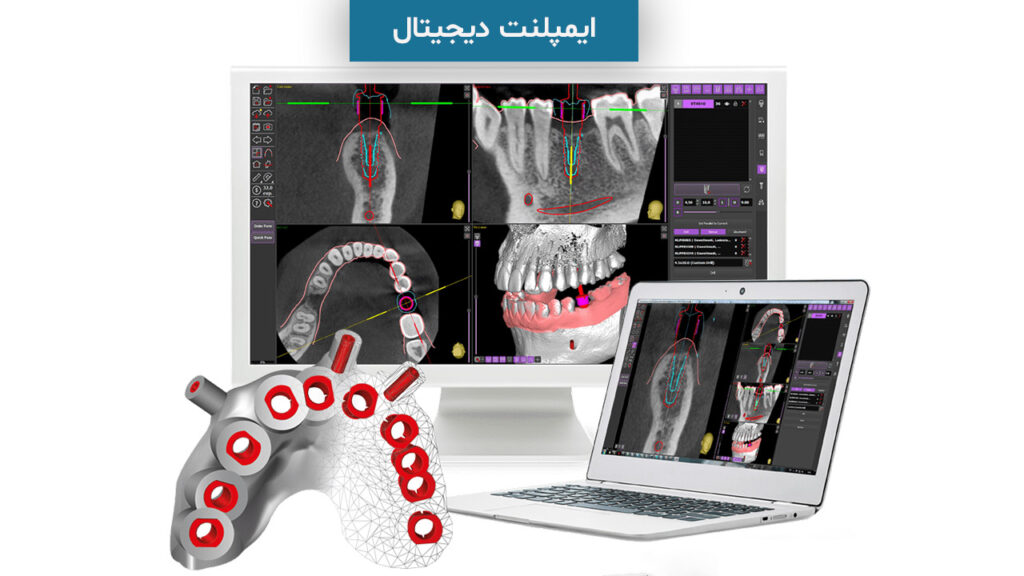 ایمپلنت دیجیتال