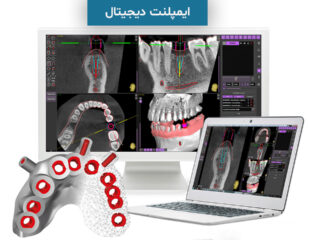 ایمپلنت دیجیتال