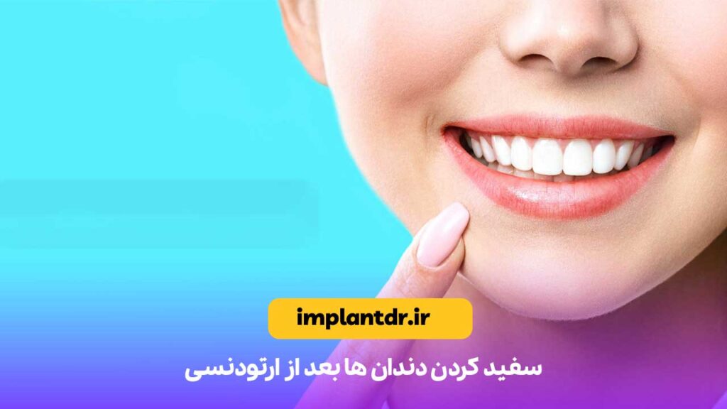 سفید کردن دندان ها بعد از ارتودنسی