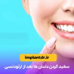 سفید کردن دندان ها بعد از ارتودنسی