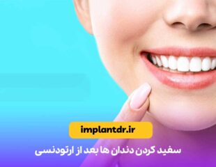 سفید کردن دندان ها بعد از ارتودنسی