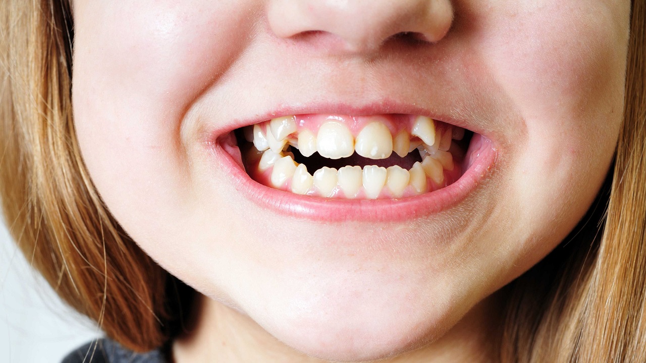 ارتودنسی دندان اضافی