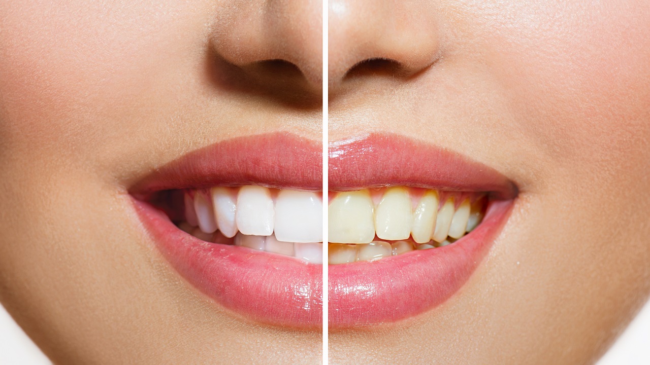 قبل و بعد سفید کردن دندان