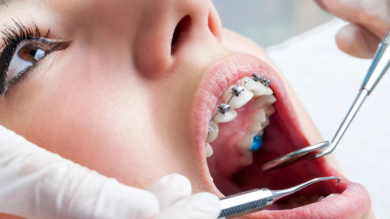 چکاپ ارتودنسی دندان