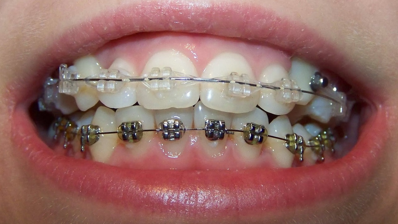 کشیدن دندان اضافی در ارتودنسی