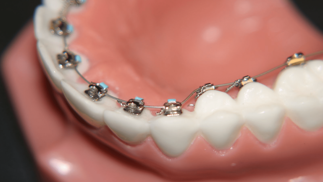 ارتودنسی نامرئی پشت دندانی