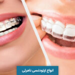 انواع ارتودنسی نامرئی