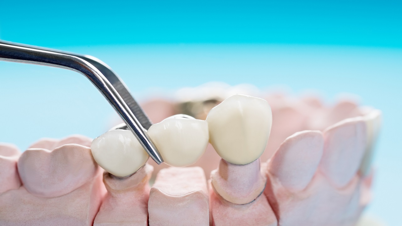 بریج دندان معمولی