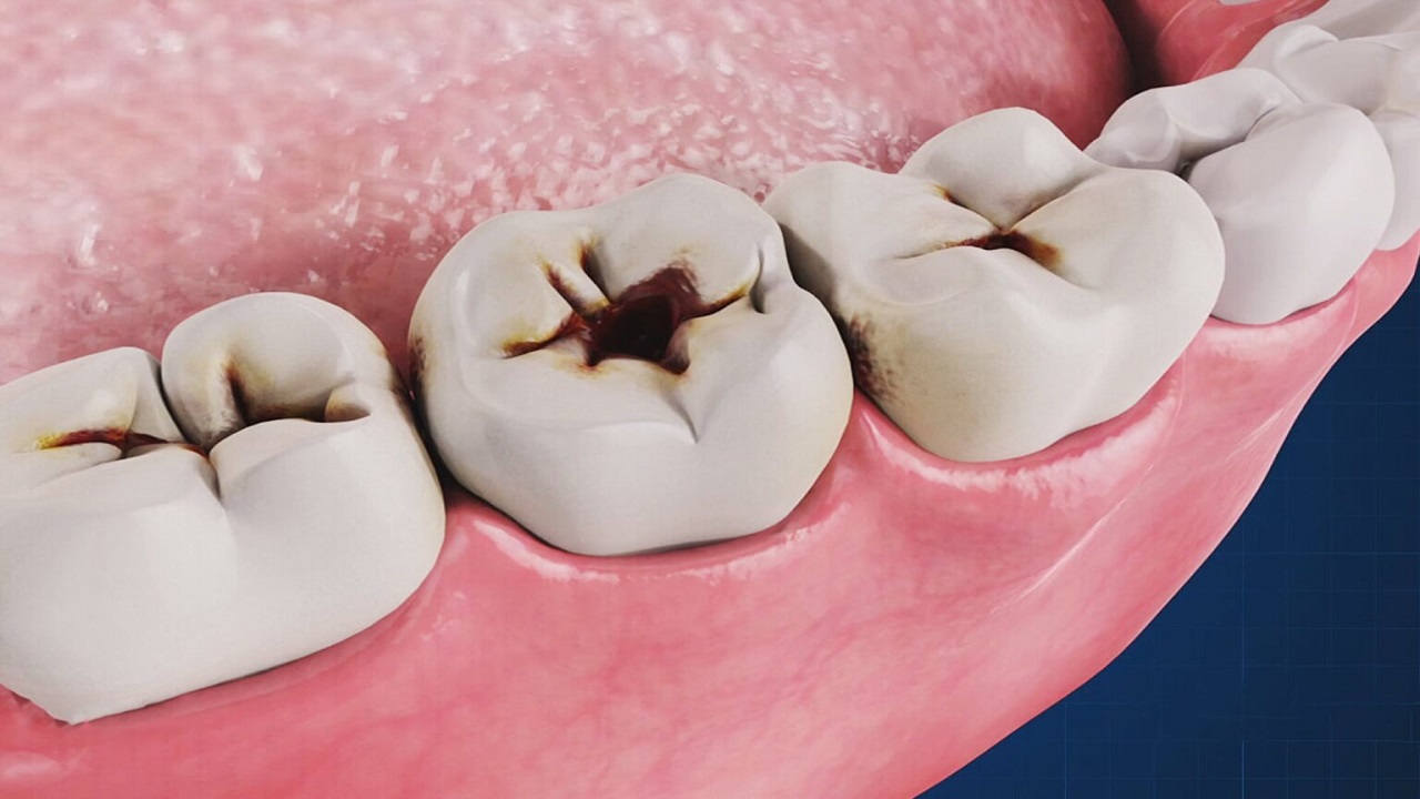 دندان های پوسیده در سطوح مختلف