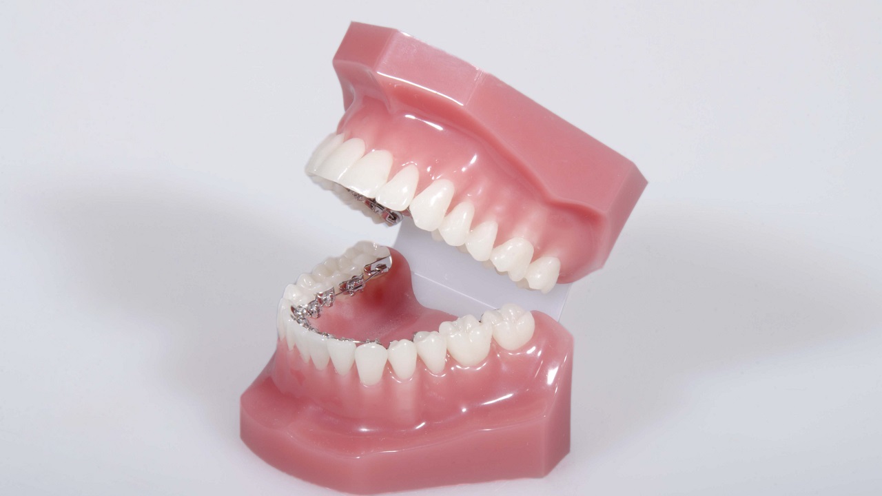 ارتودنسی لینگوال چیست؟ مزایا، معایب و هزینه
