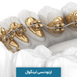 ارتودنسی لینگوال