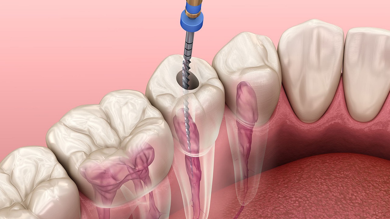 ایجاد حفره هنگام عصب کشی دندان