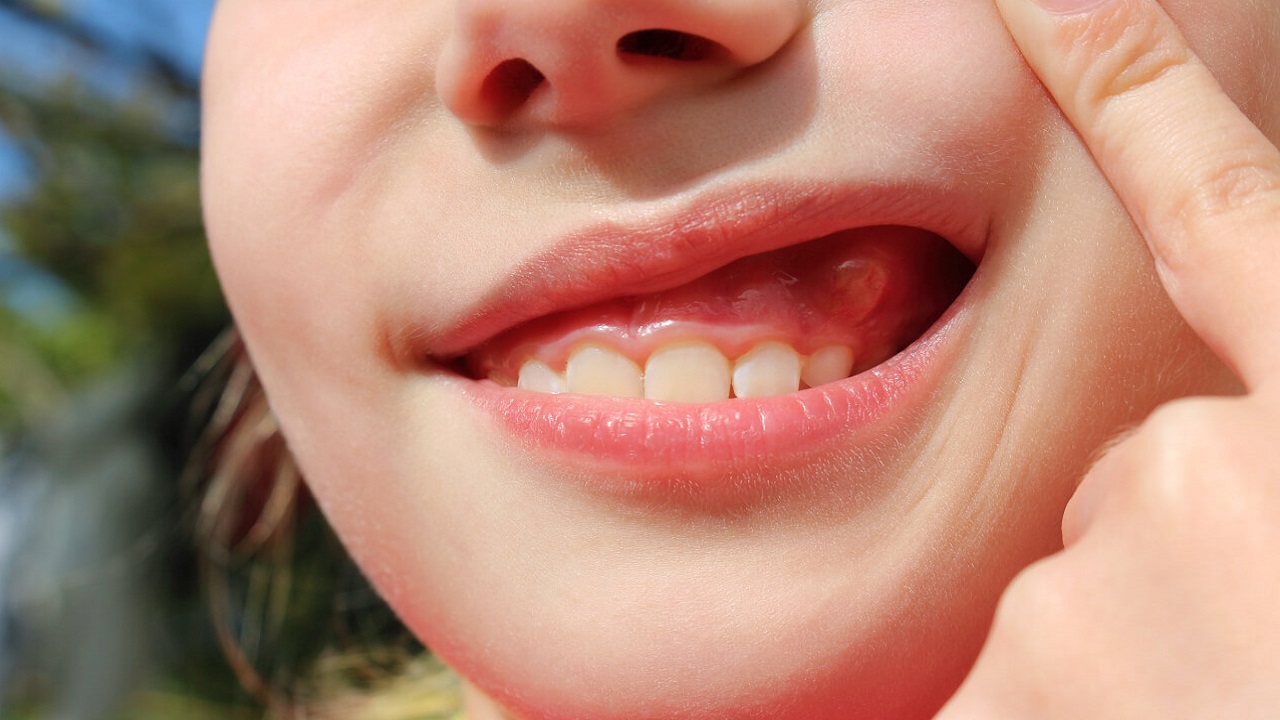 عفونت و چرک آبسه دندان