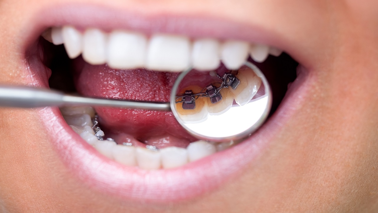معاینه ارتودنسی پشت دندان