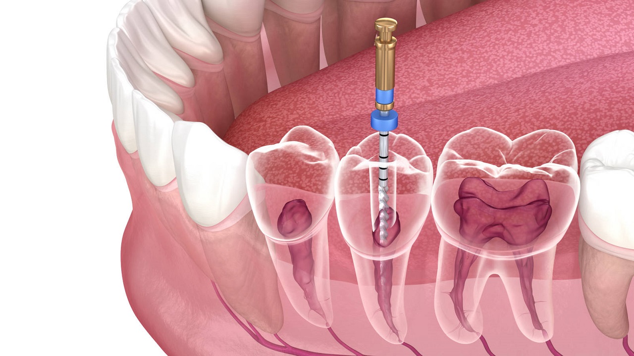 درمان شکستگی دندان با درمان ریشه
