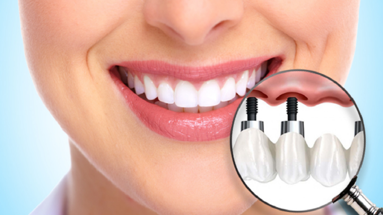 طبیعی بودن ایمپلنت دندان در دهان فرد