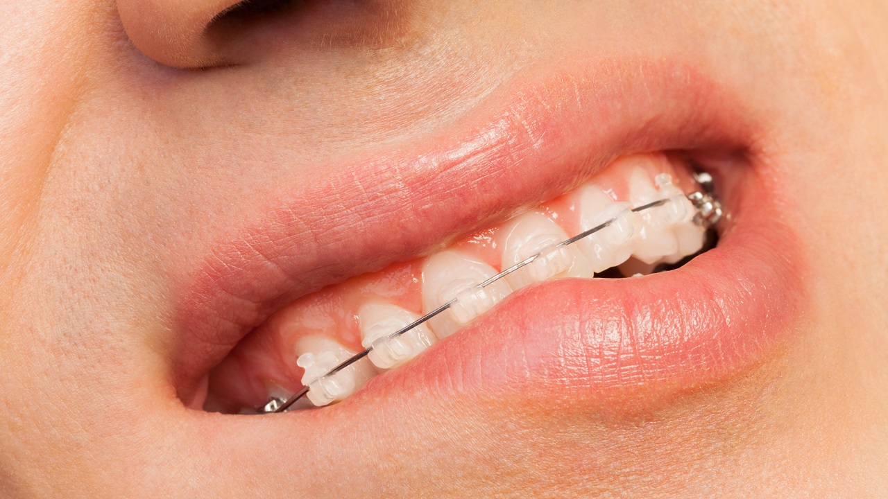 درد حین ارتودنسی دندان