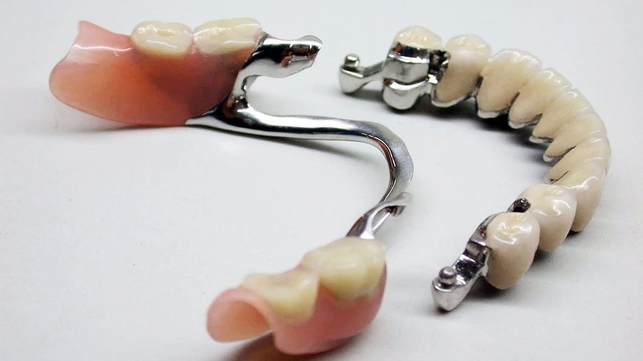 دندان مصنوعی با پایه فلزی