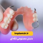 دندان مصنوعی تکه ای