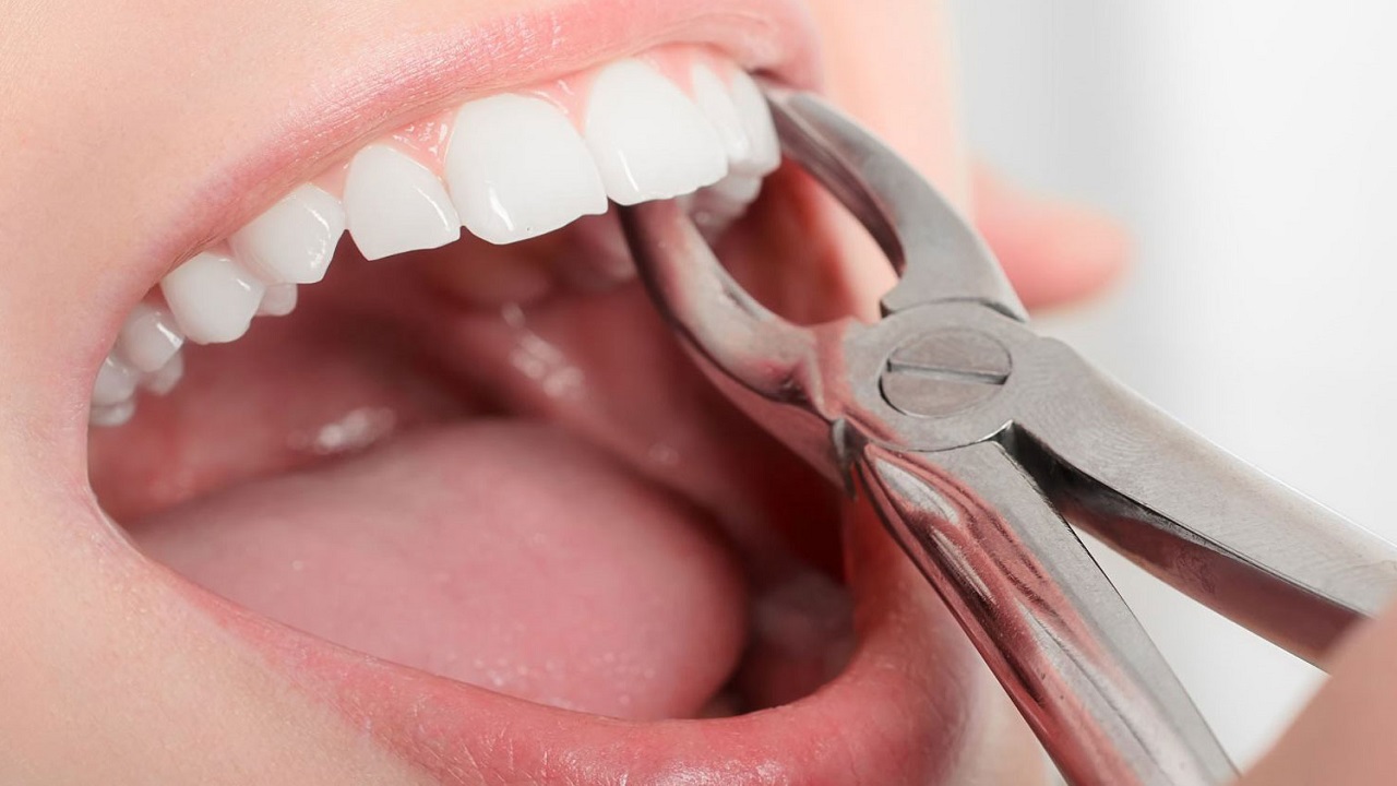 کشیدن دندان قبل از ایمپلنت دندان