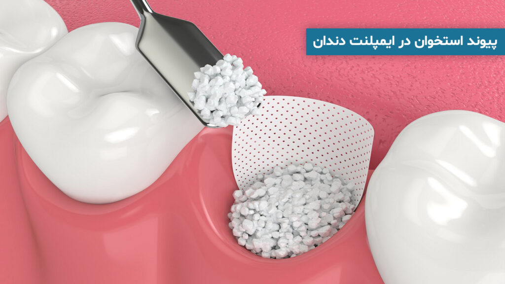 پیوند استخوان در ایمپلنت دندان