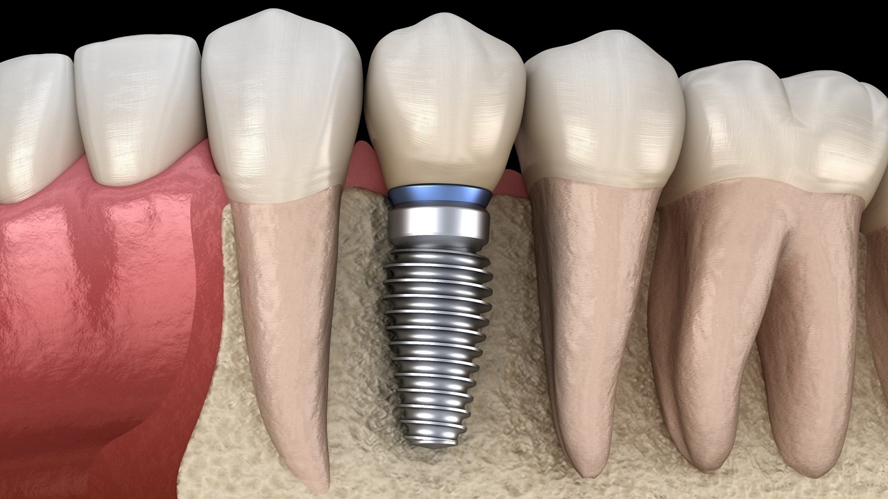 کاشت ایمپلنت دندان با بهترین مواد