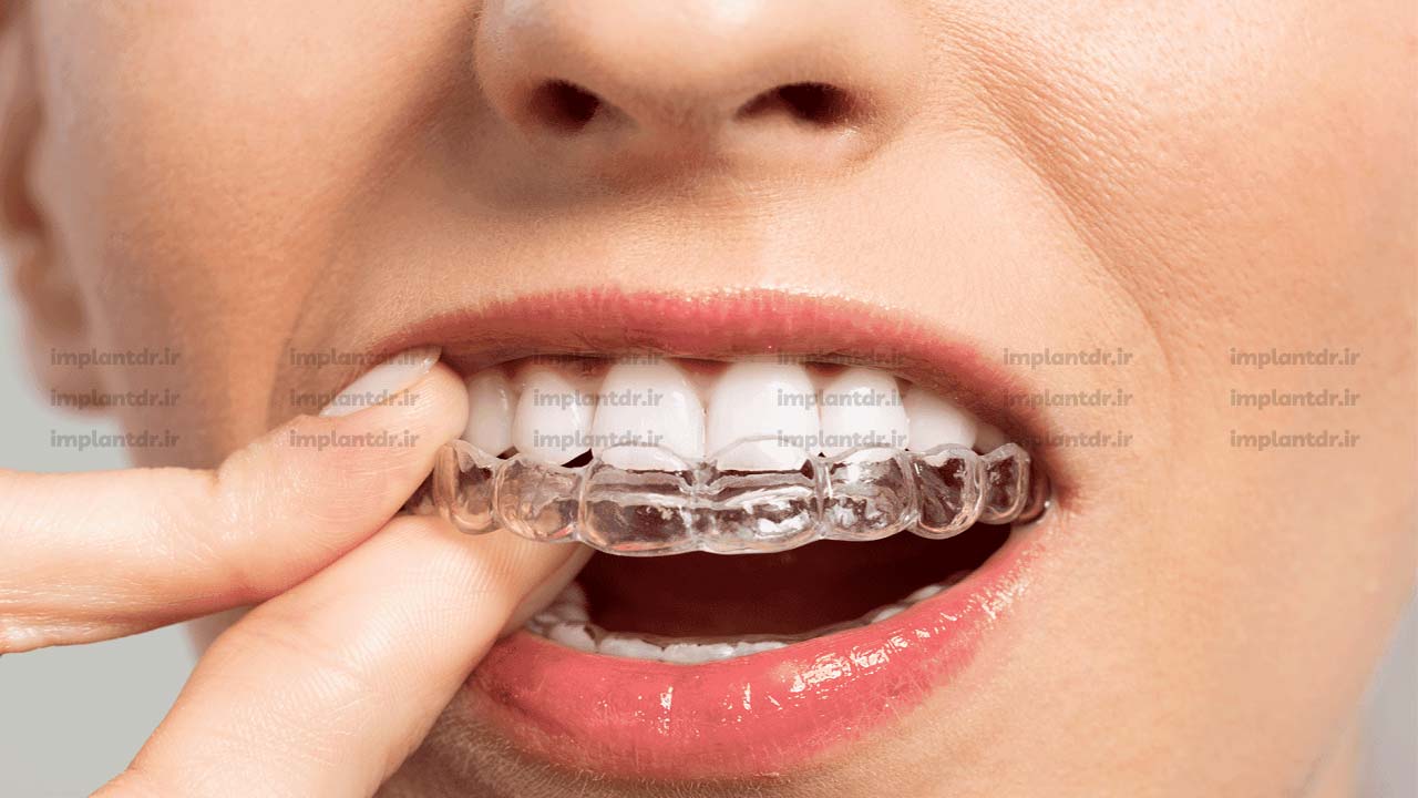 ارتودنسی نامرئی با پلاک شفاف