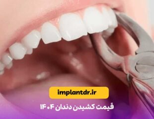 قیمت کشیدن دندان