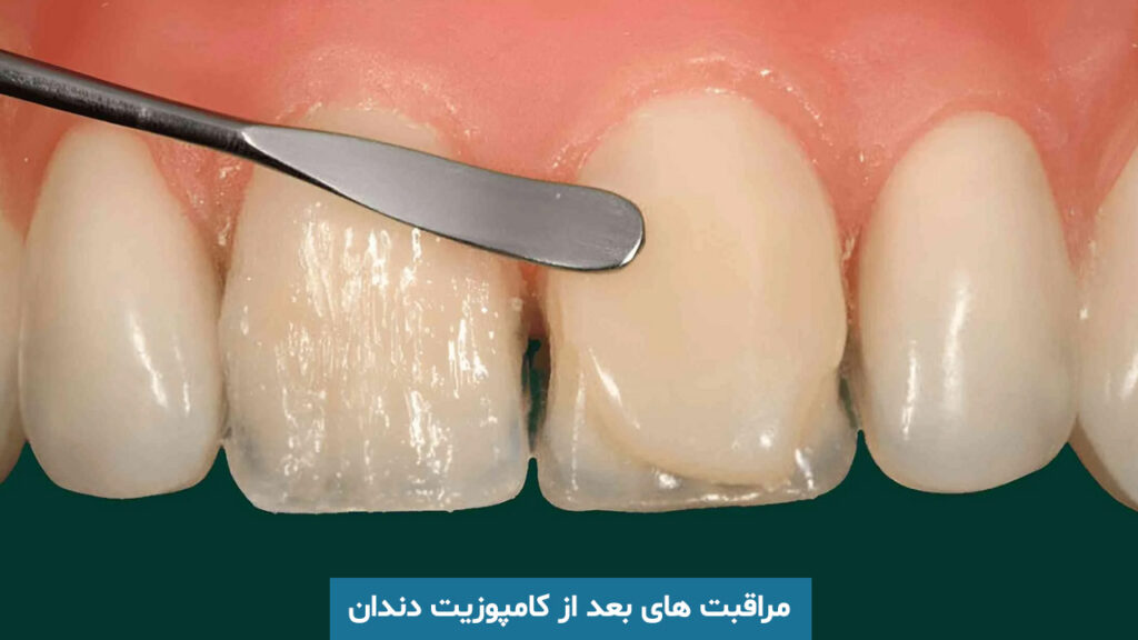 مراقبت های بعد از کامپوزیت دندان