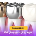 هزینه روکش دندان