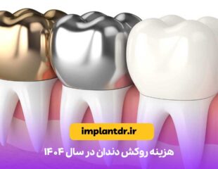 هزینه روکش دندان