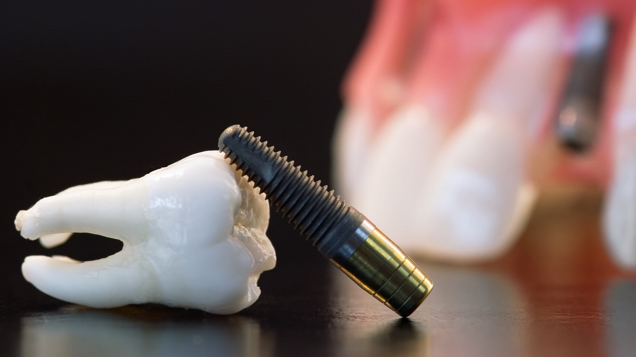 پایه ایمپلنت دندان