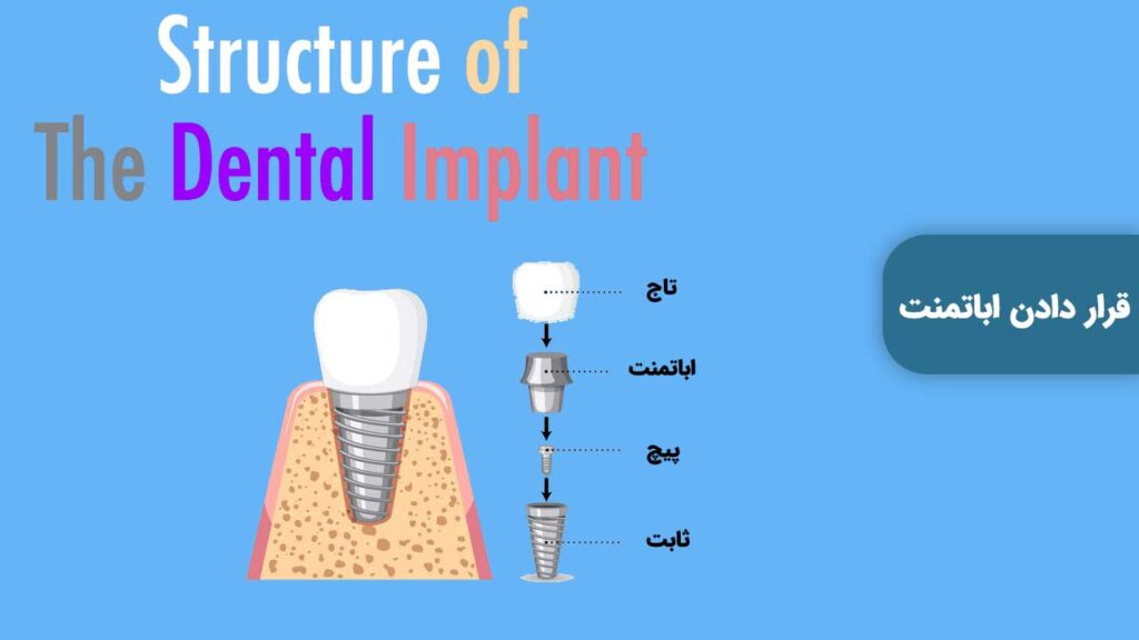 قرار دادن اباتمنت