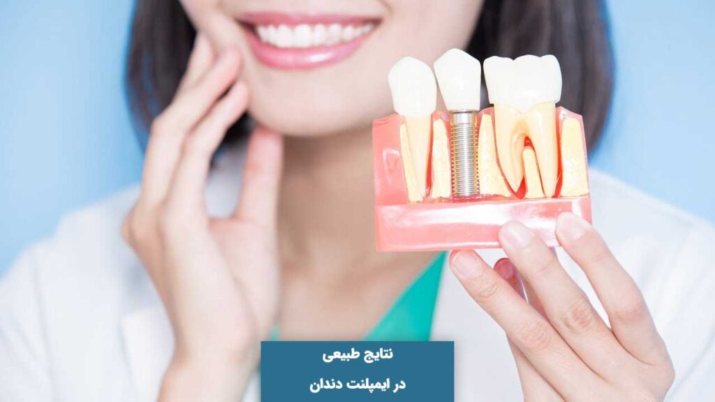 نتیاج طبیعی در ایمپلنت دیو