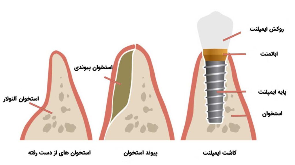 نحوه پیوند استخوان