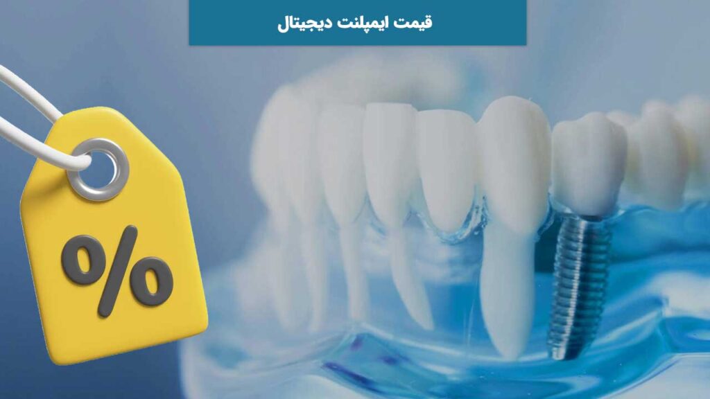 قیمت ایمپلنت دیجیتال