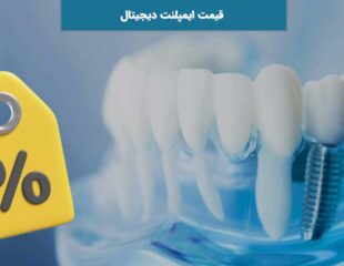قیمت ایمپلنت دیجیتال