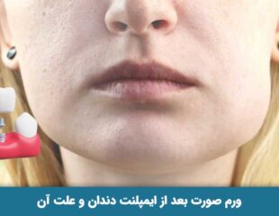 ورم صورت بعد از ایمپلنت دندان