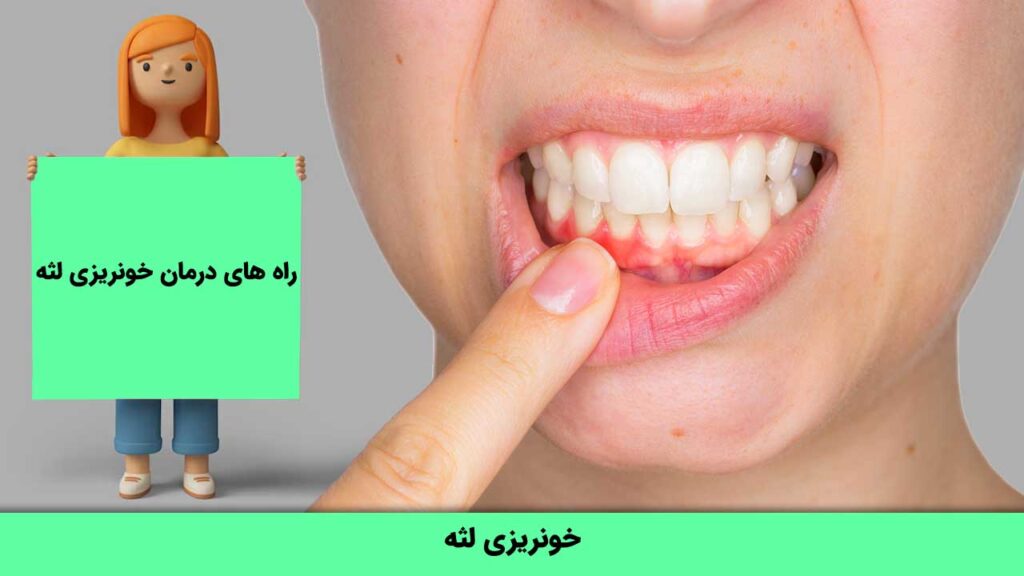 راه های درمان خونریزی لثه