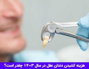 هزینه کشیدن دندان عقل